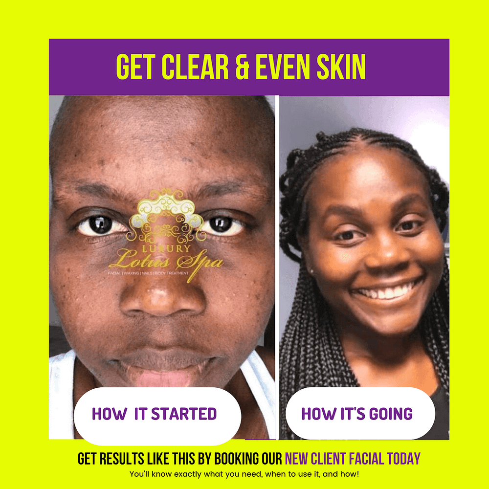How to clear Acne, post acne dark spots, and ingrown hairs in the chin area in Tampa Florida near USF - Facial Spas near me - black owned spa - black esthetician in Florida - Black Estheticians in United States of 