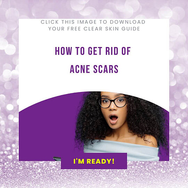 How to get rid of acne scars and post acne dark spots from the comfort of your home - Copy of Sage Elegant New Blog Post Instagram Post, luxury lotus spa, esther the esthetician, black esthetician, post acne dark spots