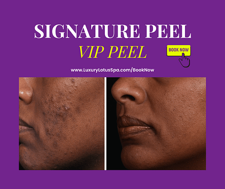  high quality chemical peel for black and brown skin by a black esthetician in tampa, Florida