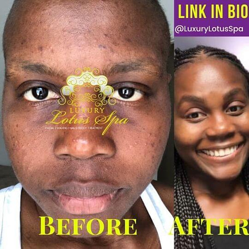 Esther The Esthetician Nelson Luxury Lotus Spa acne scars specialist in tampa fl for melanin beauties