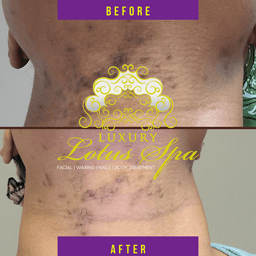 Luxury-Lotus-Spa-Esther-the-esthetician-Clear-skin-bootcamp-Before-and-After-Instagram-Post.png