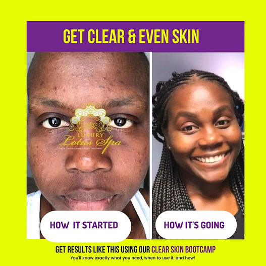 How to clear Acne, post acne dark spots, and ingrown hairs in the chin area in Tampa Florida near USF - Facial Spas near me - black owned spa - black esthetician in Florida - Black Esthetic ians in United States of The-Ultimate-Glow-Up-TOOL-My-Skin-Buddy-msb-Luxury-Lotus-Spa-Esther-The-Esthetician-Tampa-Florida.png