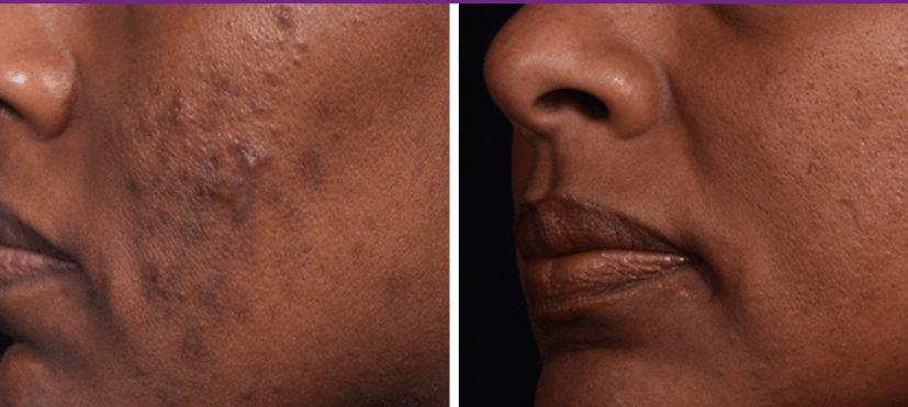 Facial of the Month - chemical peels on brown and black skin for black esthetician in tampa florida esther Nelson (10) Luxury Lotus Spa med spa