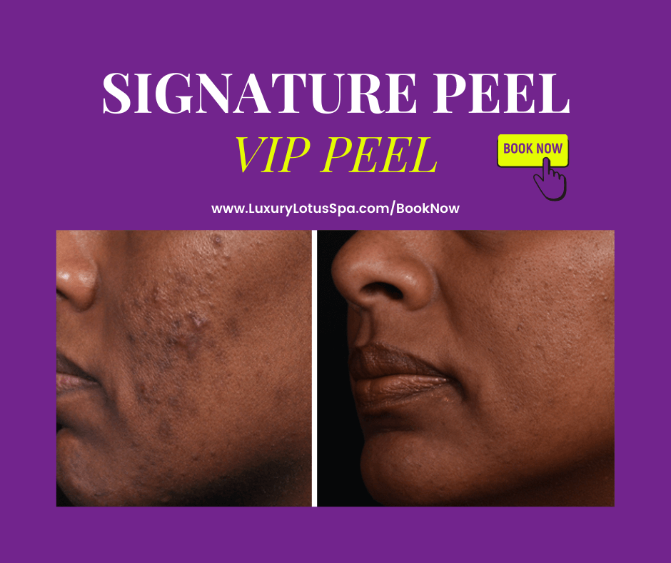 chemical peel for black and brown skin by a black esthetician in tampa, Florida