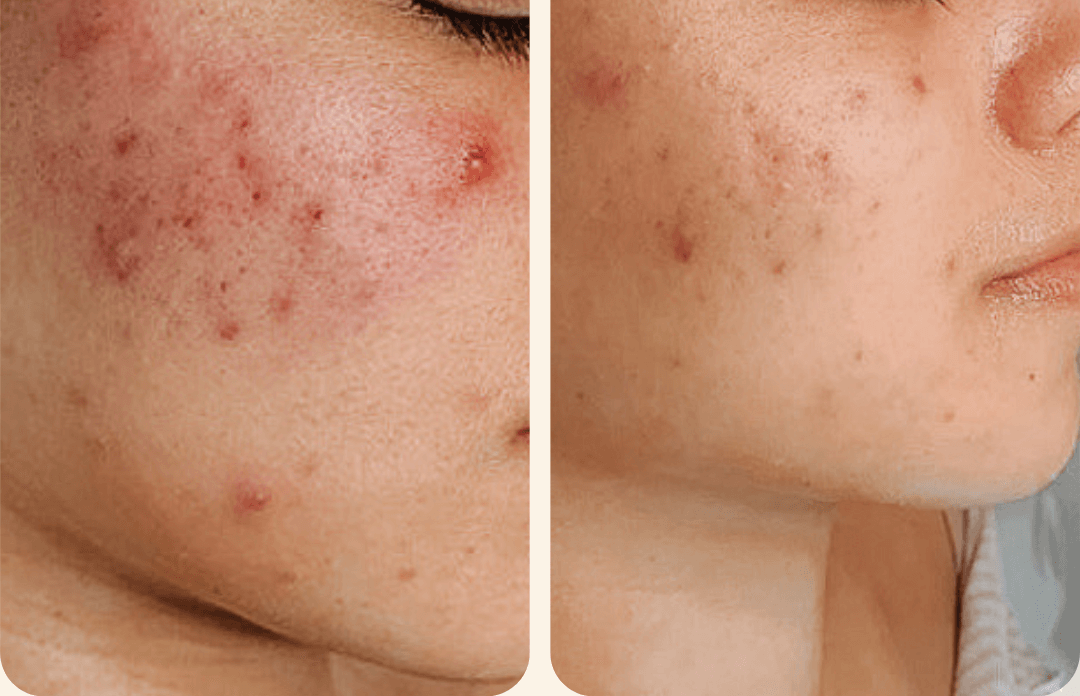 DEEP PORE CLEANSING CLEAR SKIN FACIAL TREATMENT DEEP PORE CLEANSING CLEAR SKIN FACIAL TREATMENT Black esthetician med spa acne scars specialist in tampa florida (FL)