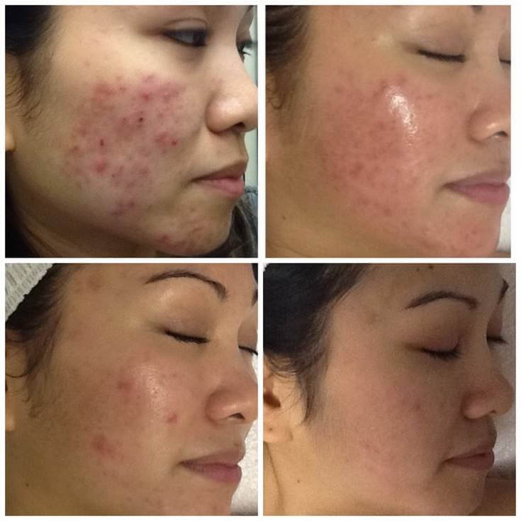 DiamdGlow Dermalinfusion facial tampa florida (FL) black esthetician DiamdGlow Dermalinfusion facial tampa florida (FL) black esthetician